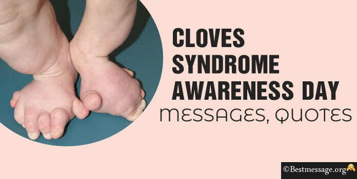 Cloves Syndrome Awareness Day Messages, Quotes